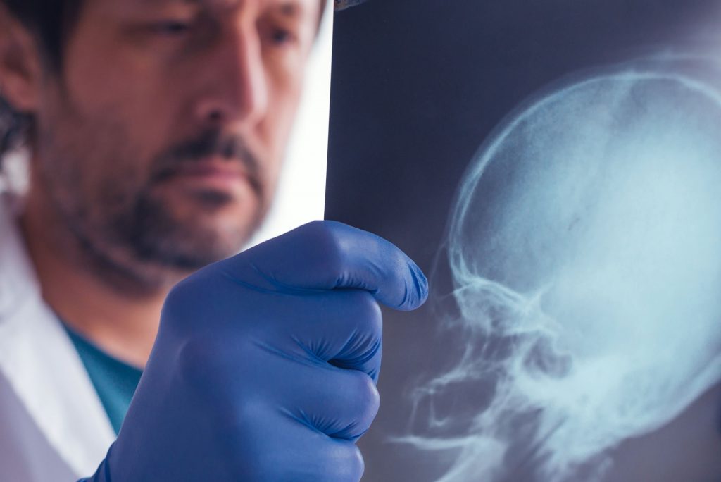 examining x-ray of skull - brain/head injury claim compensation Bradford